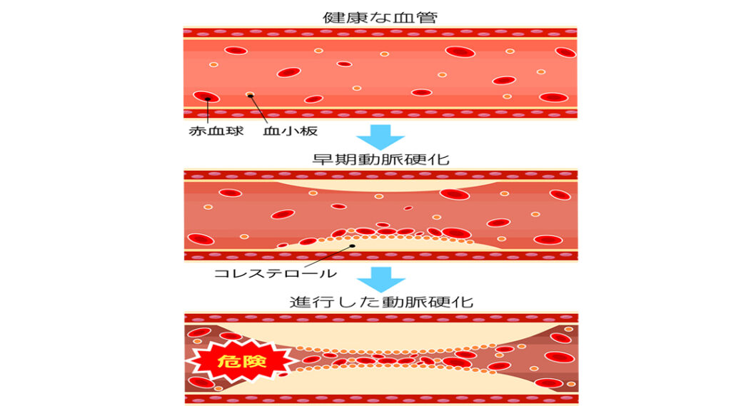 コレステロール