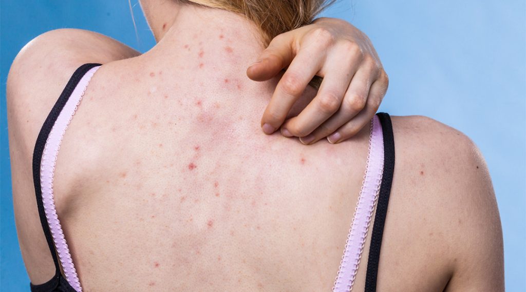 背中ニキビ